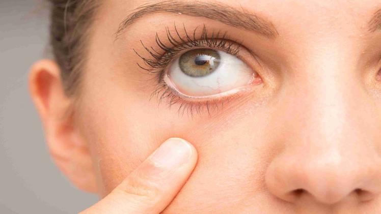 Dry Eye: Symptoms, Causes, and Treatment